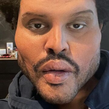 Besuch beim Beauty-Doc? The Weeknd schockt mit neuem Look!
