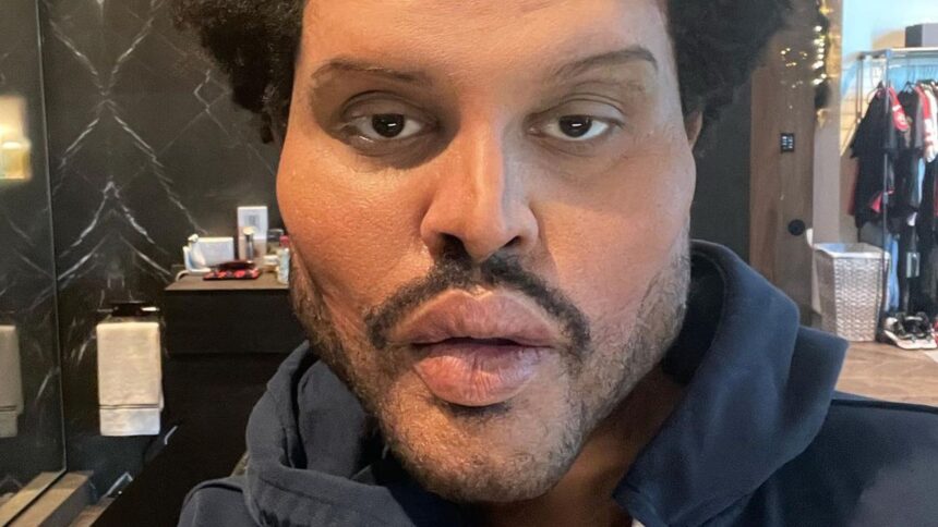 Besuch beim Beauty-Doc? The Weeknd schockt mit neuem Look!