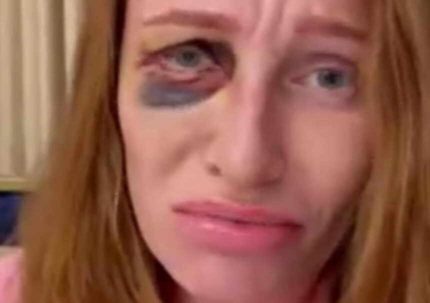 Schock-Fotos mit blauem Auge: Jetzt spricht Georgina Fleur Schock-Fotos mit blauem Auge: Jetzt spricht Georgina Fleur